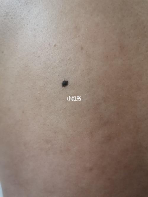 背上形状不规则的痣要不要做手术切掉?
