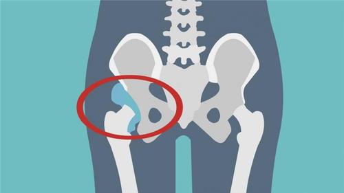 髋关节活动受限的原因有哪些_髋关节活动受限的原因是