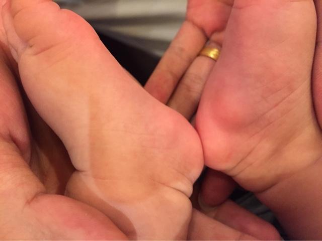 宝宝脚后跟内侧脚心往后点有疙瘩两个脚丫都有正常吗?