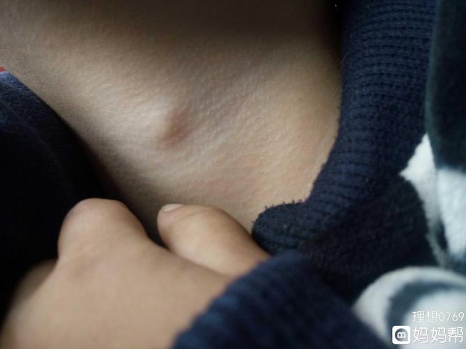 宝宝喉咙处长了个包包是什么啊.