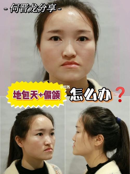 地包天 偏颌7215她是如何矫正的716015_牙齿矫正_牙套_脸型