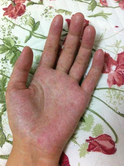 整个手掌红白相间是怎么回事,做过肝功能