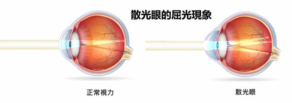 原创什么是散光有哪些危害