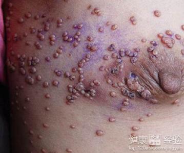 慢性腹泻也是某些艾滋病人的十分明显的早