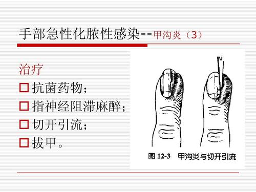 治疗   抗菌药物;   指神经阻滞麻醉;   切开引流;   拔甲