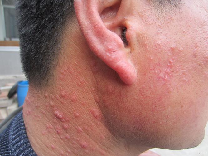 多形性日光疹 - 皮肤及性传播疾病讨论版 - 爱爱医-医