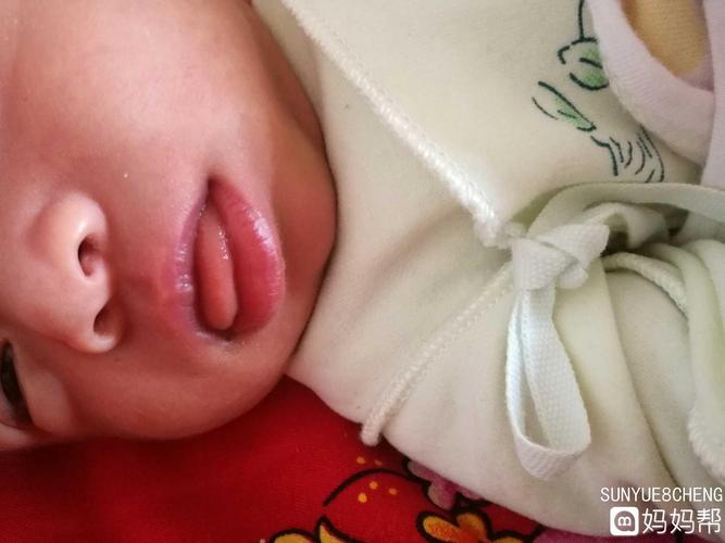 新生儿嘴唇