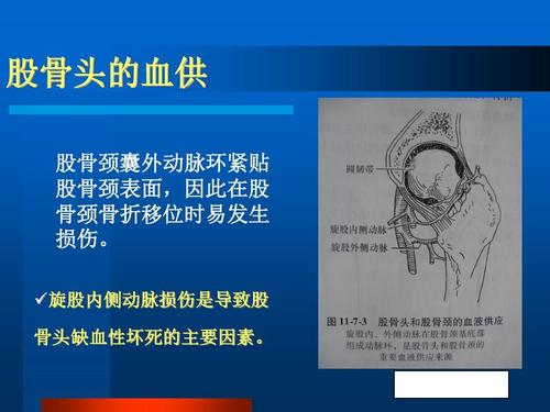 股骨颈骨折_.ppt
