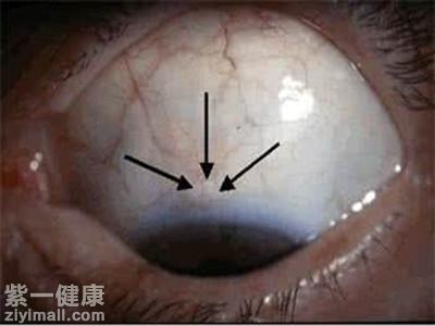 青光眼怎么得的 及早眼科检查最为重要