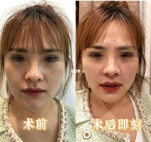 苹果肌法令纹填充_法令纹_苹果肌_整形_玻尿酸_美妆