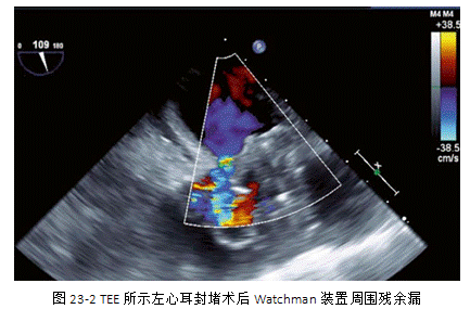 左心耳封堵术并发症的防治