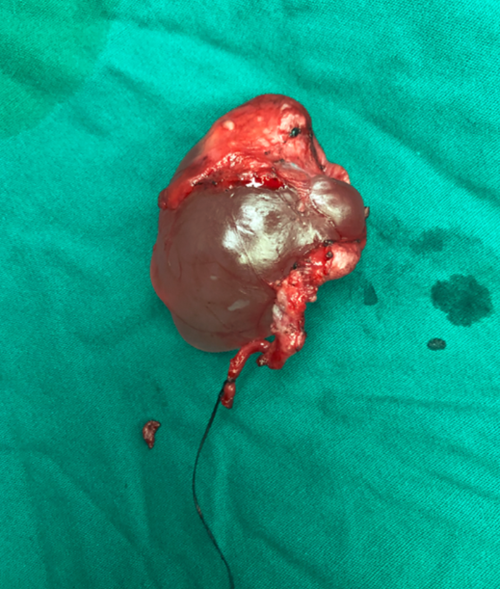 左侧附睾囊肿直径超过睾丸,临床上比较罕见,而且患者居然一直耐受50余