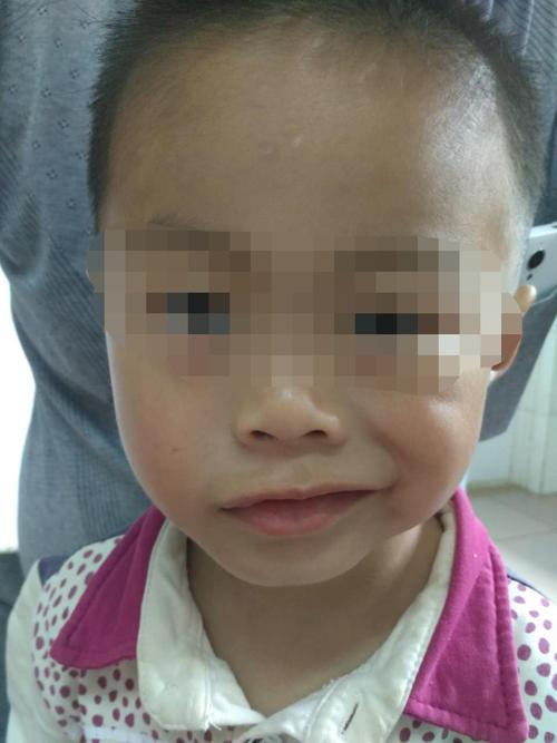 我院针灸治疗儿童面瘫有奇效