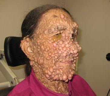 首个1型神经纤维瘤病药物!