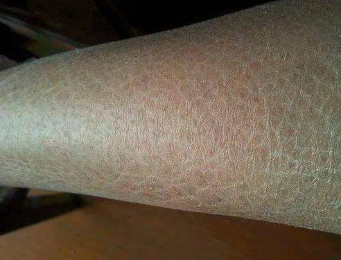 不知有多少灸友在秋季会出现这样的状况,小腿皮肤干到掉皮,如蛇皮鱼鳞