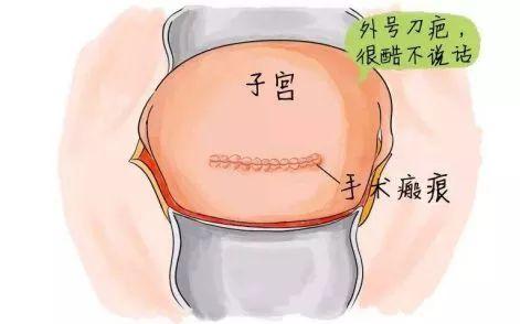 冉莹颖三胎产子差点摘除子宫她遇上医生最怕的事