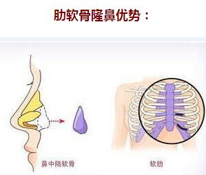 杭州时光整形案例女版"伏地魔"自体肋软骨隆鼻日记
