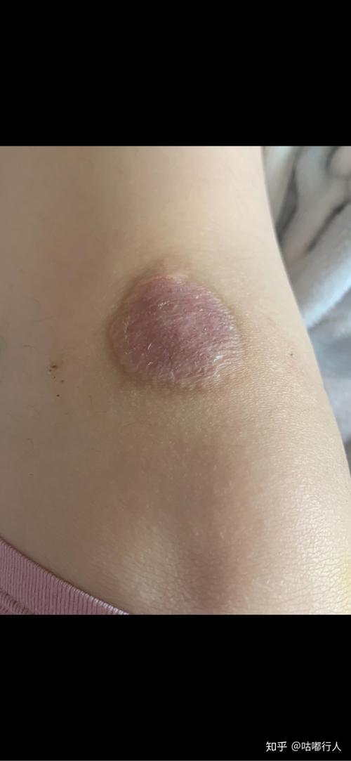 膝盖部位摔伤附图