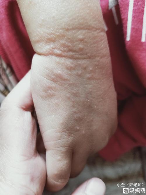 大家有没有治疗沙土性皮炎的有效方法?孩子