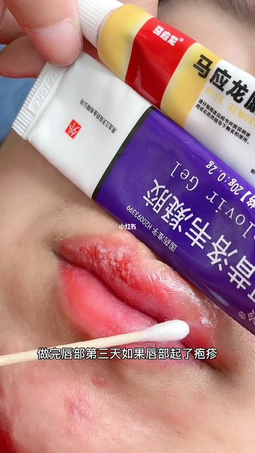 唇部起了疱疹怎么办_疱疹_唇部_半永久培训_美妆_医美