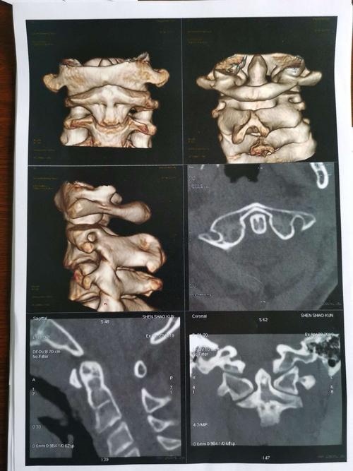 颈椎环枢关节三维ct示环枢左右间隙不一致,右宽左窄,前后间隙距约3mm
