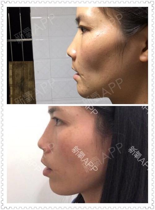 嘴巴有点难看,不太喜欢现在闭上嘴巴的样子, 是不是还肿了?