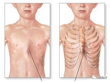 孕校素材小儿鸡胸是佝偻病吗维生素d缺乏会引起小儿鸡胸吗对生长发育