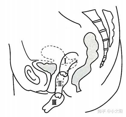 子宫脱垂分度示意图【1】