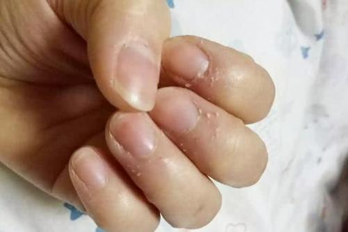 手指倒刺,维生素,干燥