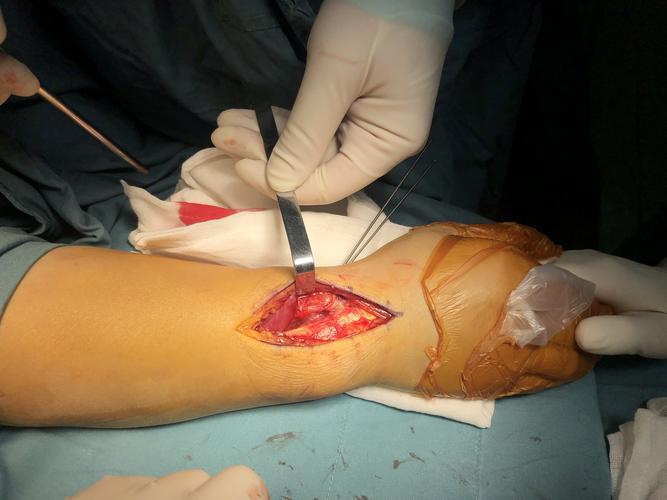 写美篇 分享一例粉碎的桡骨远端骨折手术,运用掌背侧联合入路进行复位