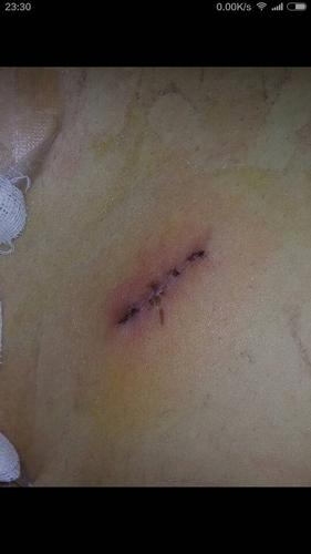 阑尾炎手术,术后到现在一个星期.伤口微微发红,周边按