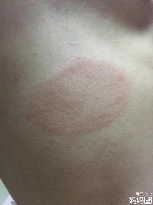 类似这种的是皮癣吗?怎么治疗?
