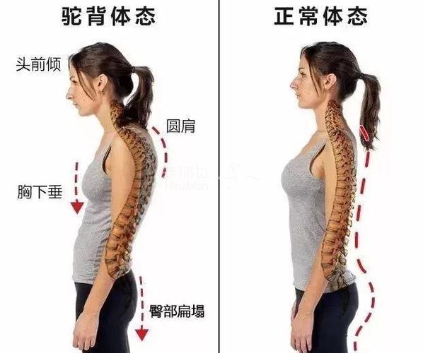 but~含胸驼背 带来的后果 不单单 是 不好看那么简单 驼背是一种较为