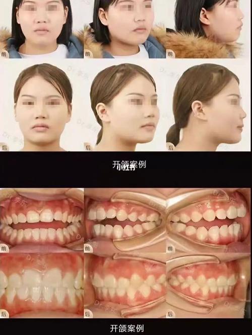「美」术前开颌/咬合异常 「奥」术后整齐/咬合正常 「案」侧脸轮廓