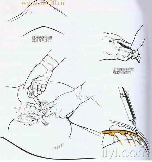 骶管阻滞图片 - 麻醉及疼痛专业资源版 - 爱爱医医学