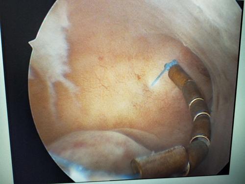 这是宫腔内节育环合并有内膜息肉.