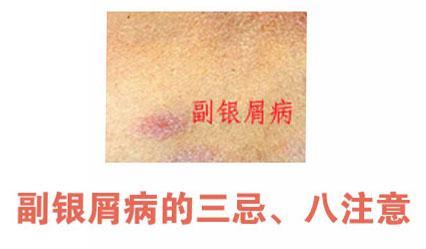 副银屑病的三忌,八注意