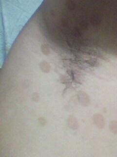 请问这是皮肤问题,还是由于身体那胛收馐汗斑吗?如何治疗呢?很急!