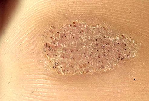 plantar warts look like hard, thick patches of skin with dark