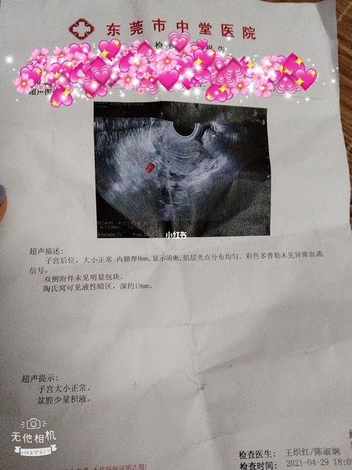今天肚子疼去医院检查医生说少量的盆腔积液,正常人也