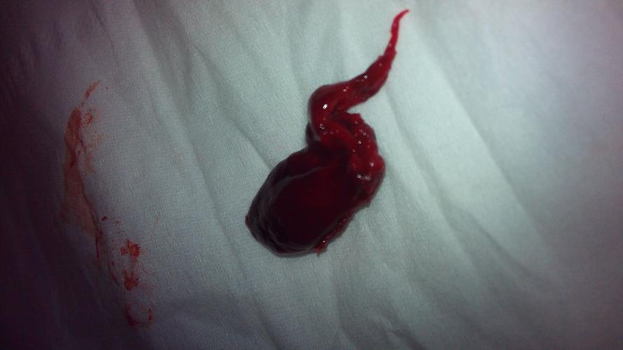 这是一个两个多月的胚胎