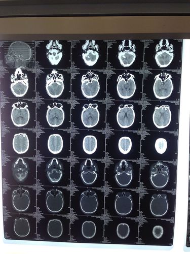 后来呕吐严重,并出现深红色血块,晚上9时转入省人民医院,急.