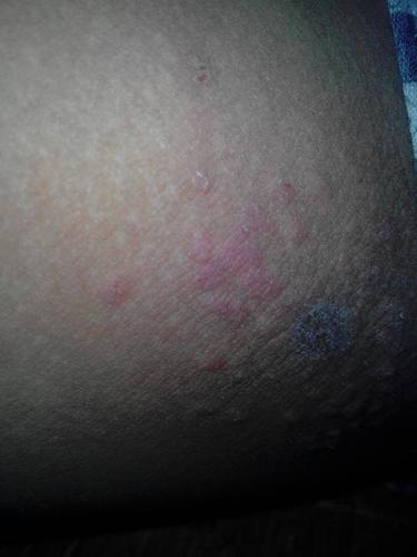 2014-03-19 王海龙 医师 夏天的时候我大腿内侧起了些湿疹 去药店拿