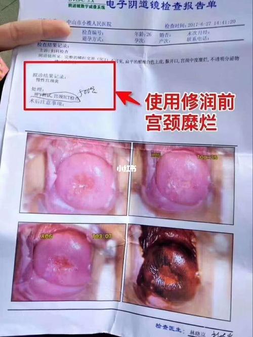 宫颈中度糜烂,慢性宫颈炎真的好了_医疗健康_医疗健康