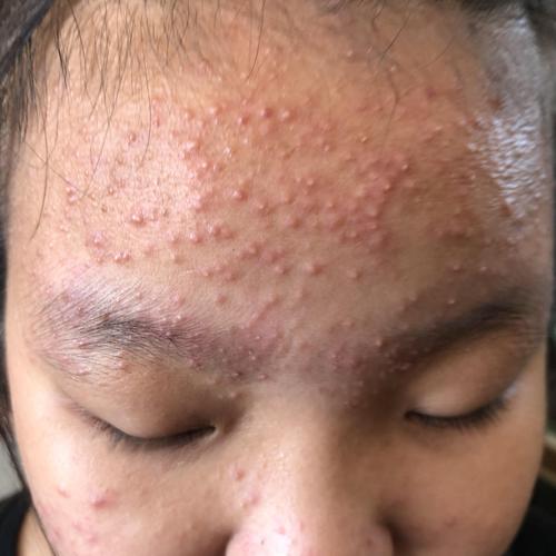脸上长一粒粒的东西一晒太阳额头上长满了小痘痘咋办