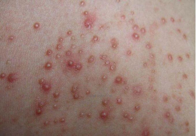 背上为什么会长痘痘?