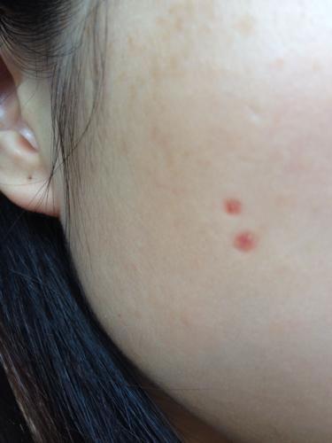 问:医生,我点了五颗黑痣,掉痂十天左右了,其他三颗恢复的很好,不知道