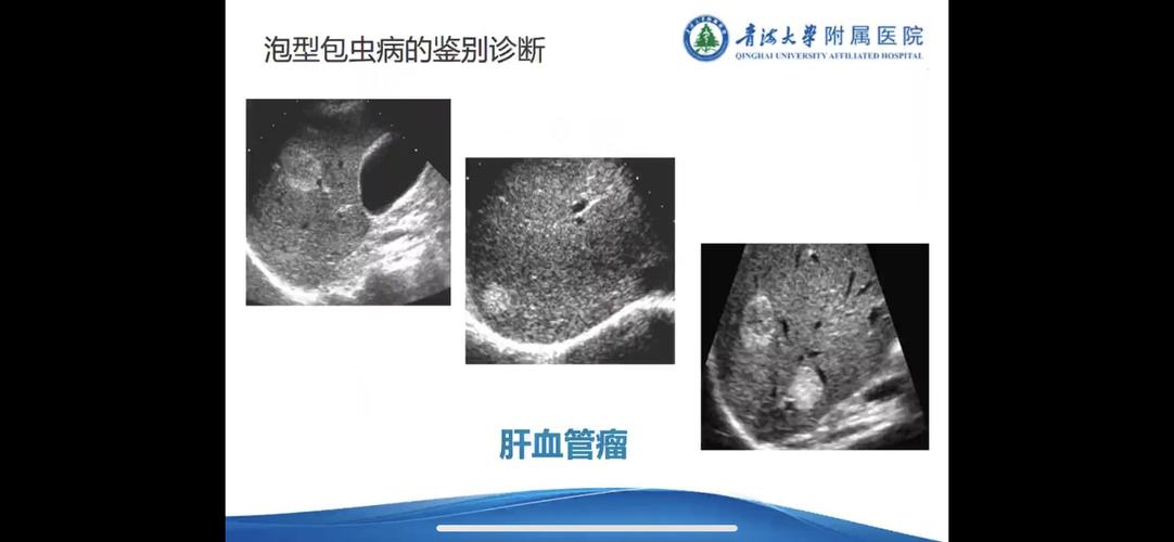 肝包虫病的超声分型与鉴别诊断