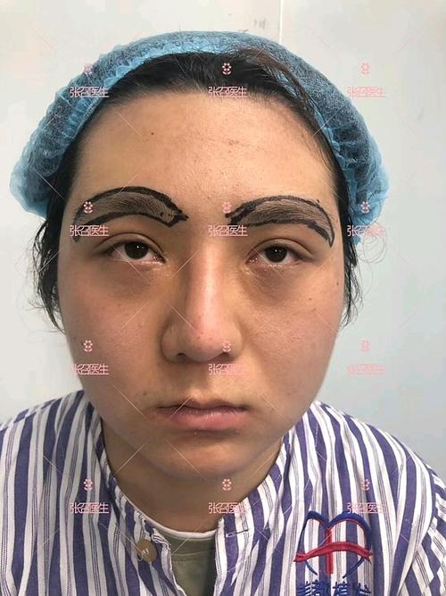 【假体垫眉弓】丰眉弓会不自然吗