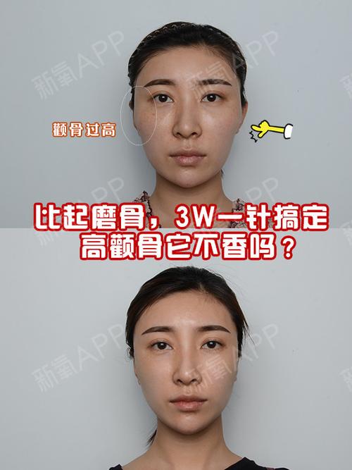 比起磨骨3w一针搞定高颧骨它不香吗
